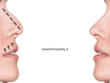 Surgical technique closed rhinoplasty