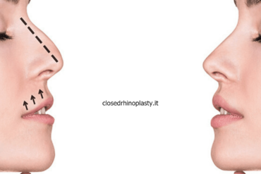 Types of closed rhinoplasty