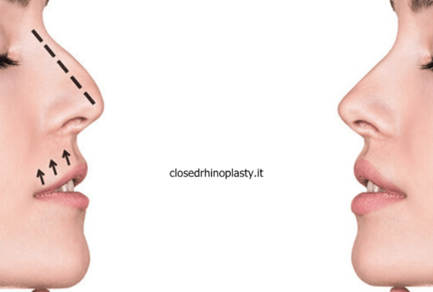 Surgical technique closed rhinoplasty