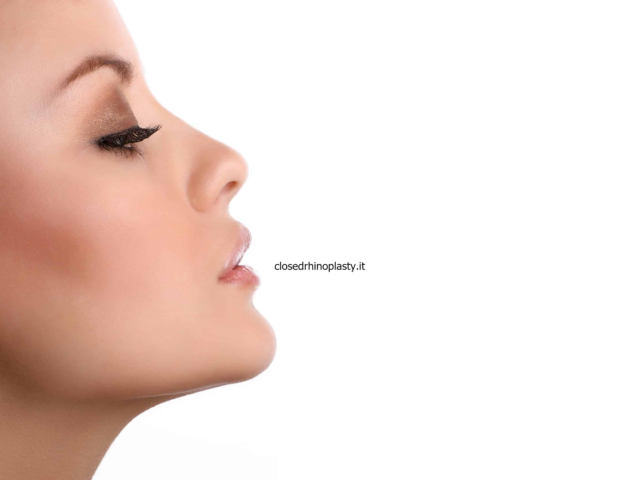 Which rhinoplasty is better – open or closed