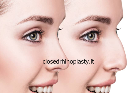 types closed rhinoplasty