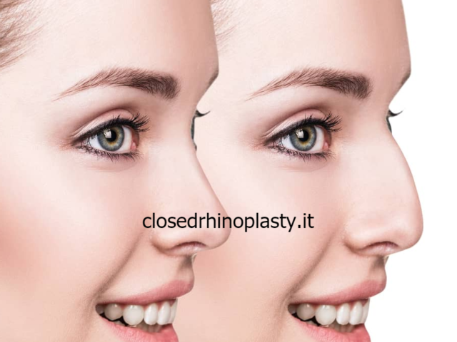 types closed rhinoplasty